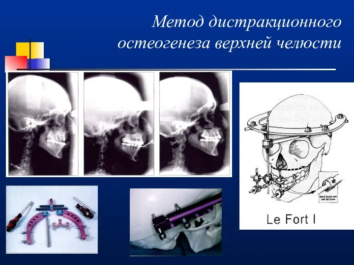 Метод дистракционного остеогенеза верхней челюсти