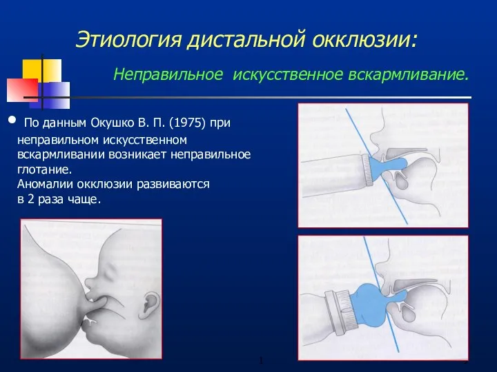 1 Этиология дистальной окклюзии: Неправильное искусственное вскармливание. По данным Окушко В.