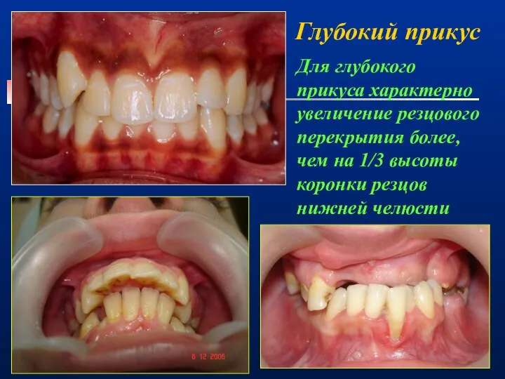 Глубокий прикус Для глубокого прикуса характерно увеличение резцового перекрытия более, чем