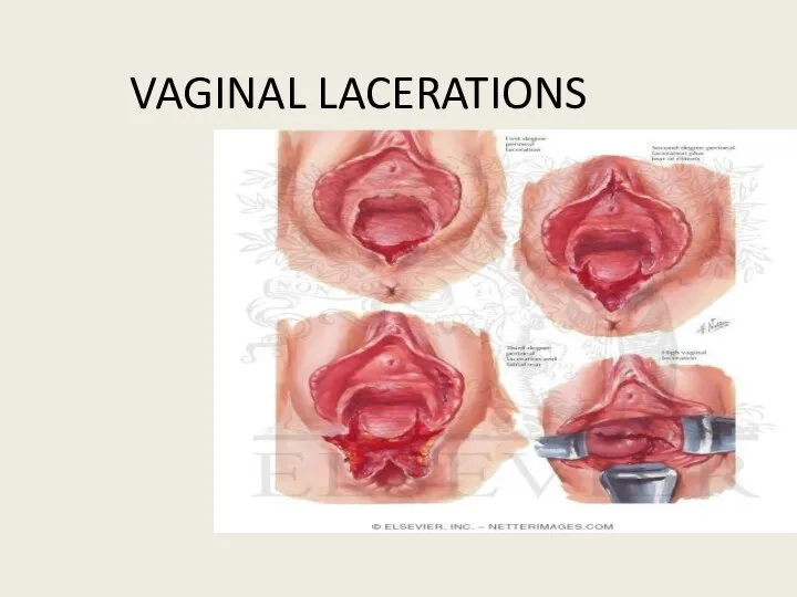 VAGINAL LACERATIONS