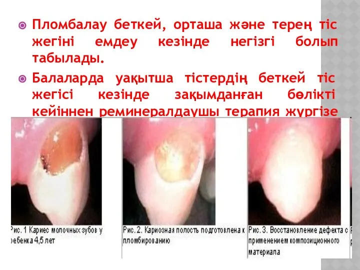 Пломбалау беткей, орташа және терең тіс жегіні емдеу кезінде негізгі болып