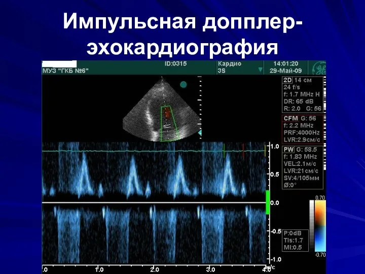 Импульсная допплер-эхокардиография