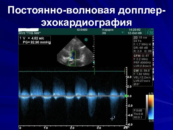 Постоянно-волновая допплер-эхокардиография