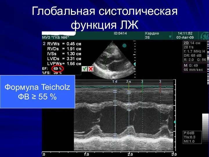 Глобальная систолическая функция ЛЖ Формула Teicholz ФВ ≥ 55 %