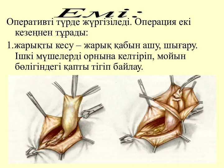 Оперативтi түрде жүргiзiледi. Операция екi кезеңнен тұрады: 1.жарықты кесу – жарық