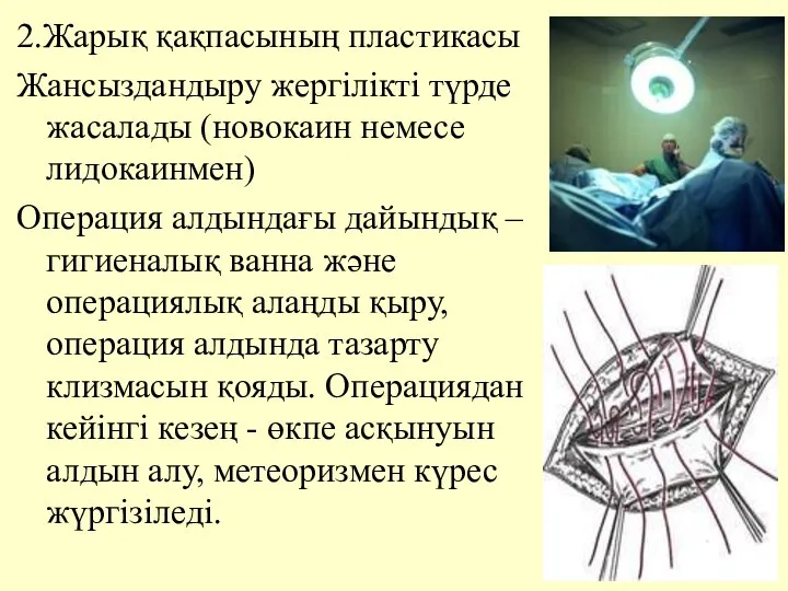 2.Жарық қақпасының пластикасы Жансыздандыру жергiлiктi түрде жасалады (новокаин немесе лидокаинмен) Операция