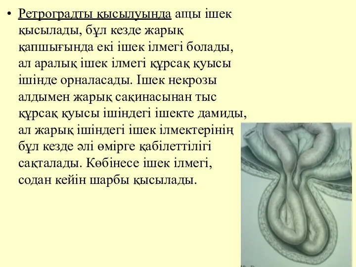 Ретроградты қысылуында ащы iшек қысылады, бұл кезде жарық қапшығында екi iшек