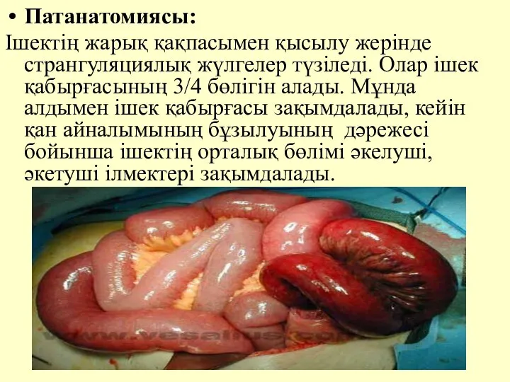 Патанатомиясы: Iшектiң жарық қақпасымен қысылу жерiнде странгуляциялық жүлгелер түзiледi. Олар iшек