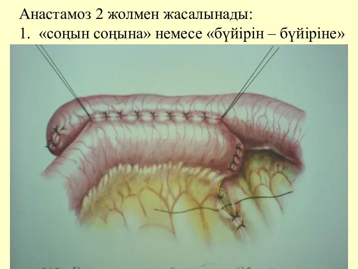 Анастамоз 2 жолмен жасалынады: 1. «соңын соңына» немесе «бүйiрiн – бүйiрiне»