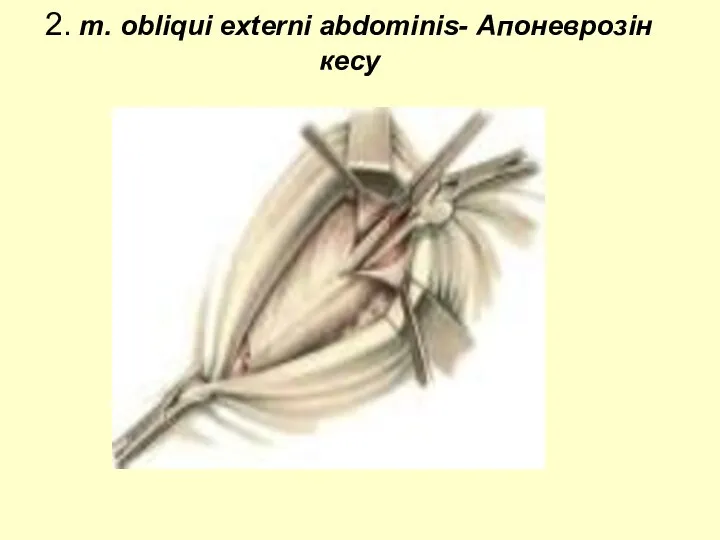 2. m. obliqui externi abdominis- Апоневрозін кесу