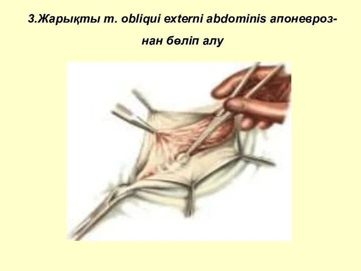3.Жарықты m. obliqui externi abdominis апоневроз- нан бөліп алу