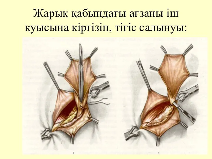 Жарық қабындағы ағзаны іш қуысына кіргізіп, тігіс салынуы: