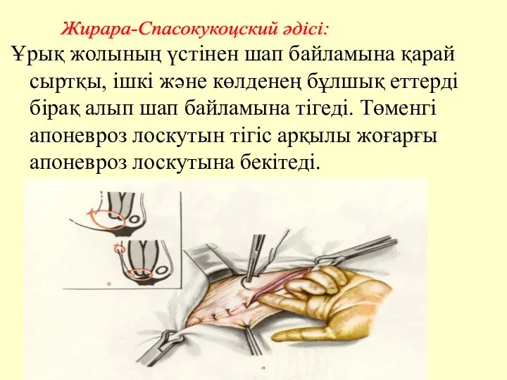 Ұрық жолының үстінен шап байламына қарай сыртқы, ішкі және көлденең бұлшық