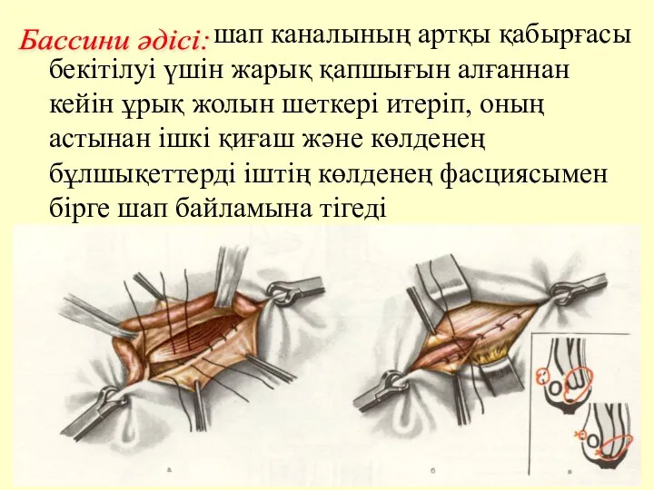 шап каналының артқы қабырғасы бекітілуі үшін жарық қапшығын алғаннан кейін ұрық