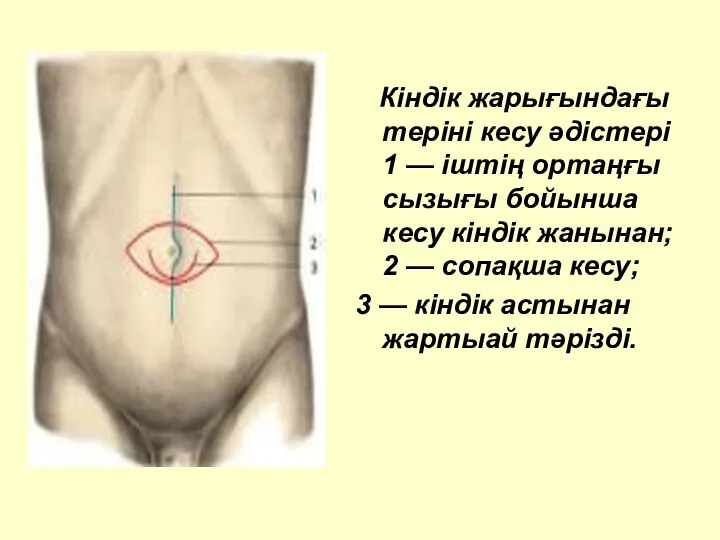 Кіндік жарығындағы теріні кесу әдістері 1 — іштің ортаңғы сызығы бойынша