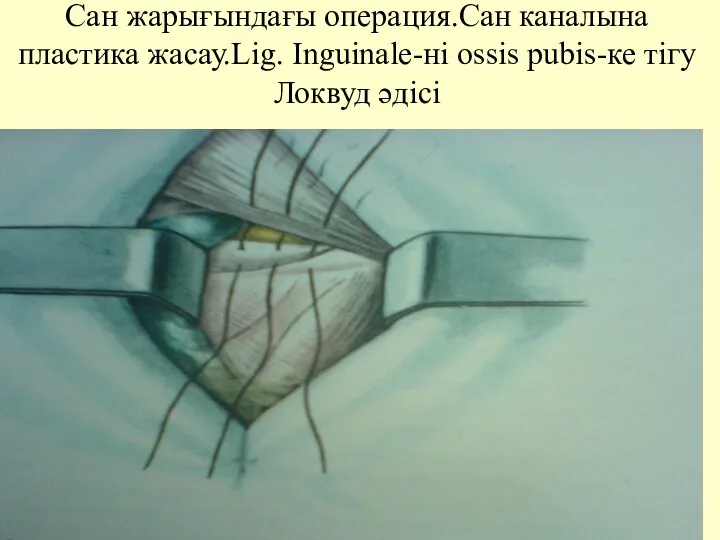 Сан жарығындағы операция.Сан каналына пластика жасау.Lig. Inguinale-ні ossis pubis-ке тігу Локвуд әдісі