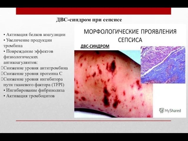 ДВС-синдром при сепсисе • Активация белков коагуляции • Увеличение продукции тромбина