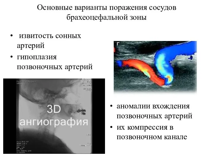 Основные варианты поражения сосудов брахеоцефальной зоны извитость сонных артерий гипоплазия позвоночных