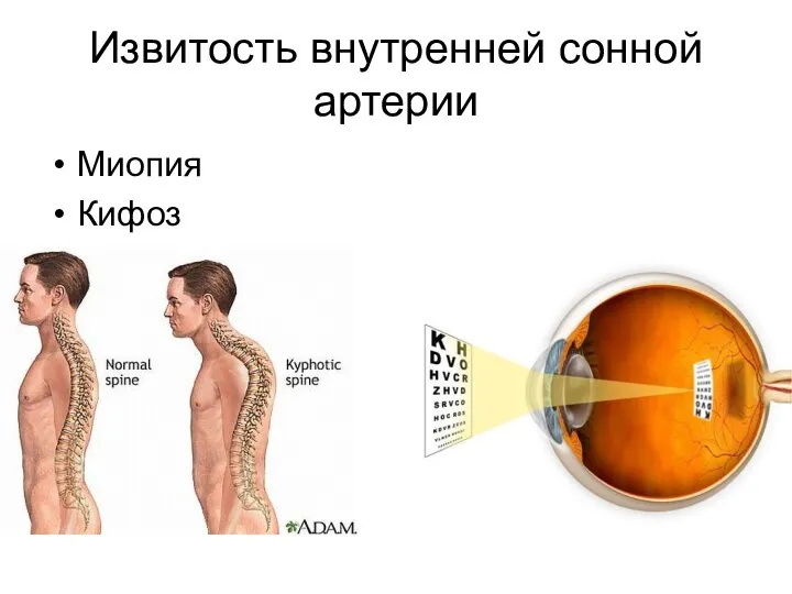 Извитость внутренней сонной артерии Миопия Кифоз