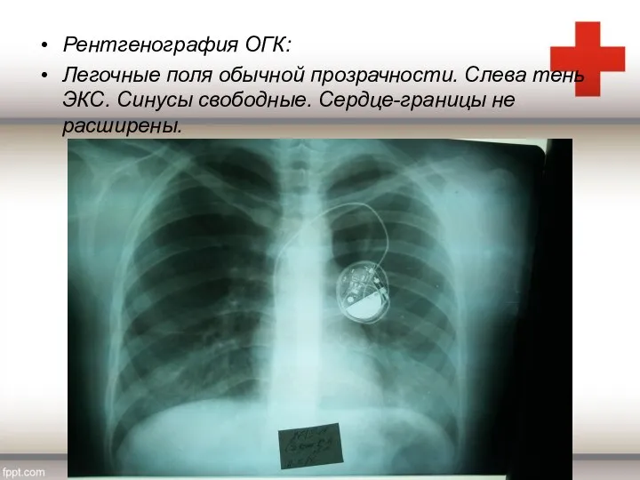 Рентгенография ОГК: Легочные поля обычной прозрачности. Слева тень ЭКС. Синусы свободные. Сердце-границы не расширены.