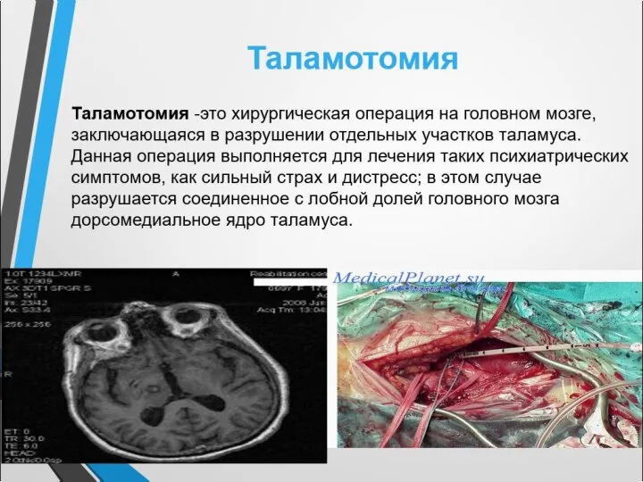 Таламотомия -это хирургическая операция на головном мозге, заключающаяся в разрушении отдельных
