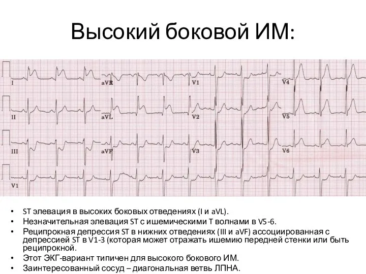 Высокий боковой ИМ: ST элевация в высоких боковых отведениях (I и