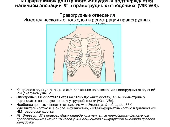 Инфаркт Миокарда Правого Желудочка подтверждается наличием элевации ST в правогрудных отведениях