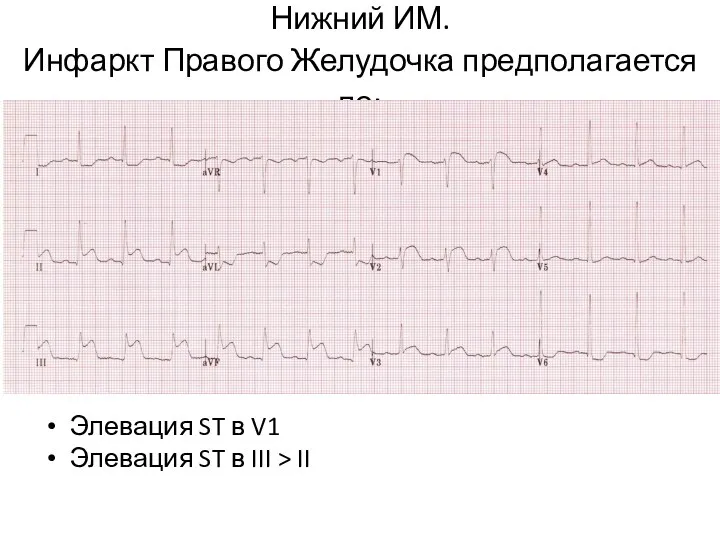Нижний ИМ. Инфаркт Правого Желудочка предполагается по: Элевация ST в V1
