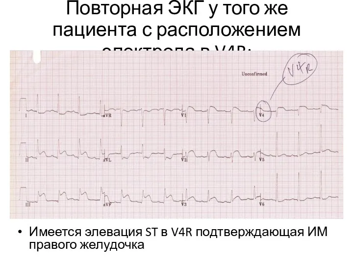 Повторная ЭКГ у того же пациента с расположением электрода в V4R: