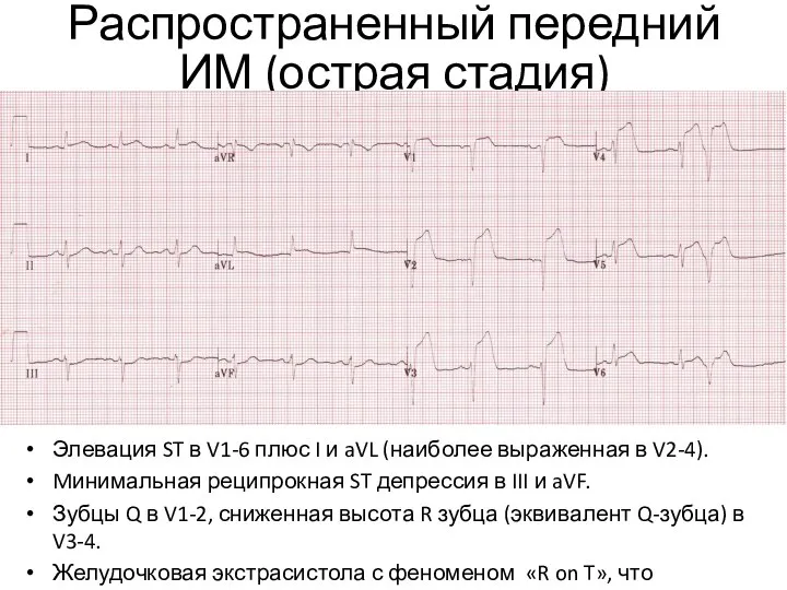 Распространенный передний ИМ (острая стадия) Элевация ST в V1-6 плюс I