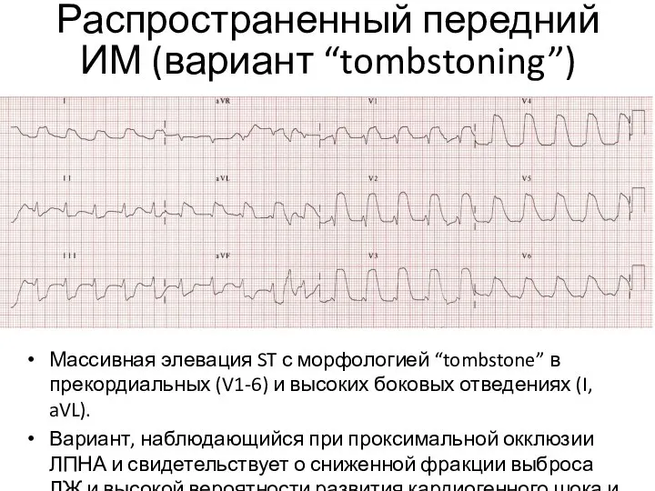 Распространенный передний ИМ (вариант “tombstoning”) Массивная элевация ST с морфологией “tombstone”
