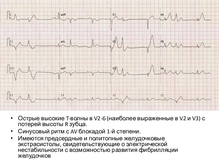 Острые высокие T-волны в V2-6 (наиболее выраженные в V2 и V3)