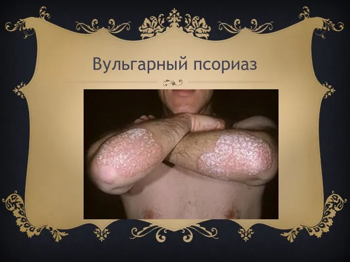 Вульгарный псориаз