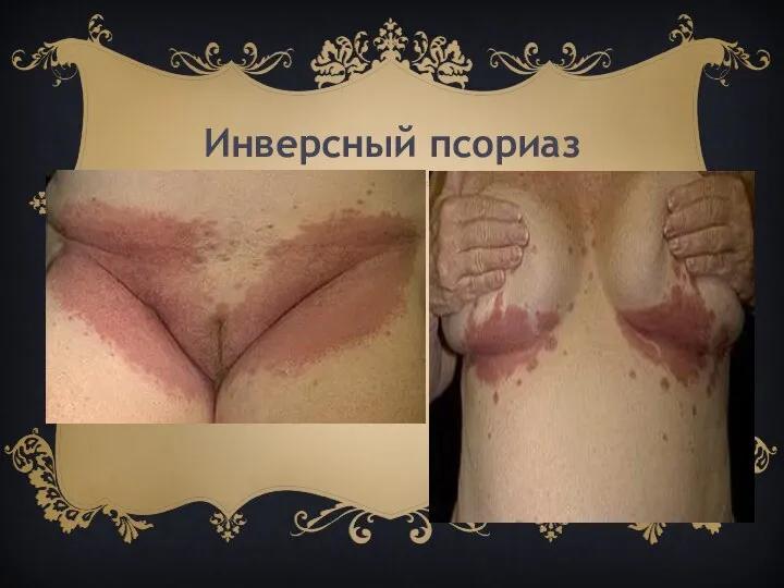 Инверсный псориаз