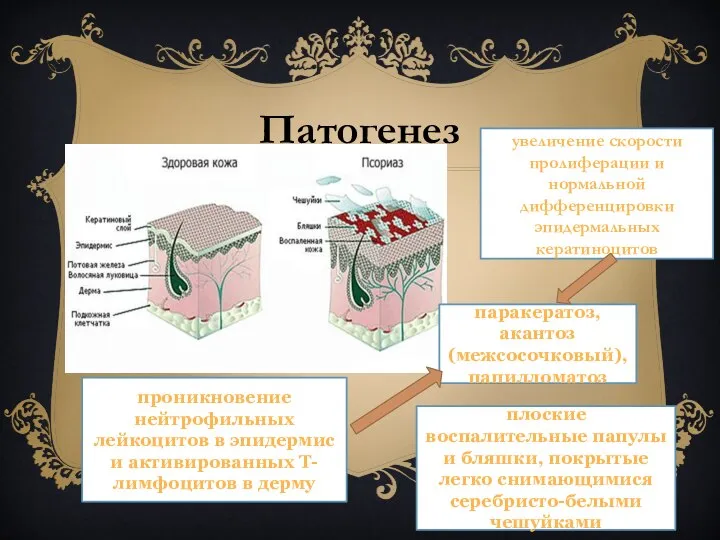 Патогенез увеличение скорости пролиферации и нормальной дифференцировки эпидермальных кератиноцитов паракератоз, акантоз