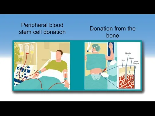 Donation from the bone Peripheral blood stem cell donation