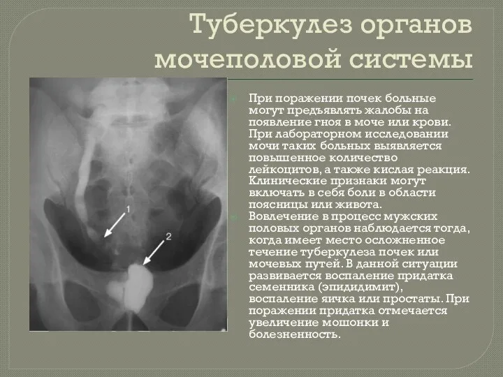 Туберкулез органов мочеполовой системы При поражении почек больные могут предъявлять жалобы