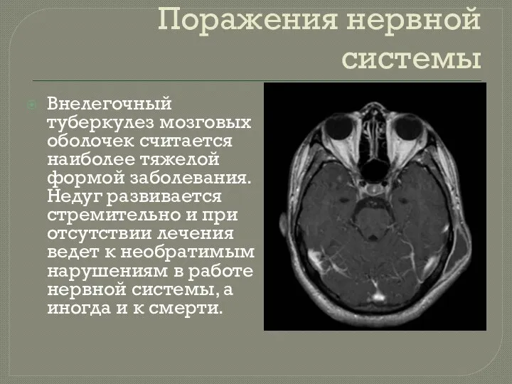 Поражения нервной системы Внелегочный туберкулез мозговых оболочек считается наиболее тяжелой формой