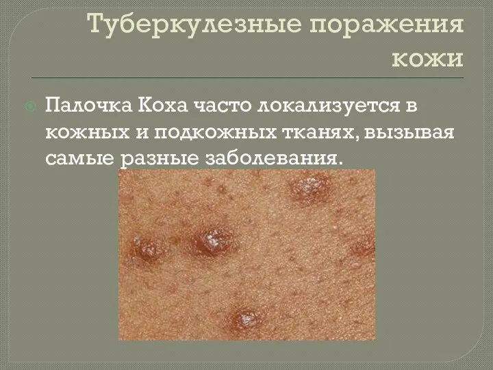 Туберкулезные поражения кожи Палочка Коха часто локализуется в кожных и подкожных тканях, вызывая самые разные заболевания.