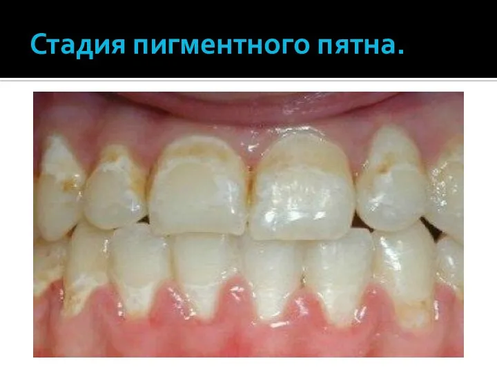 Стадия пигментного пятна.