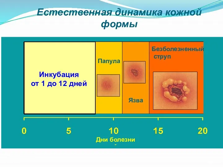 Инкубация от 1 дo 12 дней Папула Язва Безболезненный струп Естественная динамика кожной формы Дни болезни