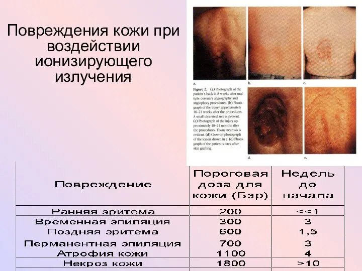 Повреждения кожи при воздействии ионизирующего излучения