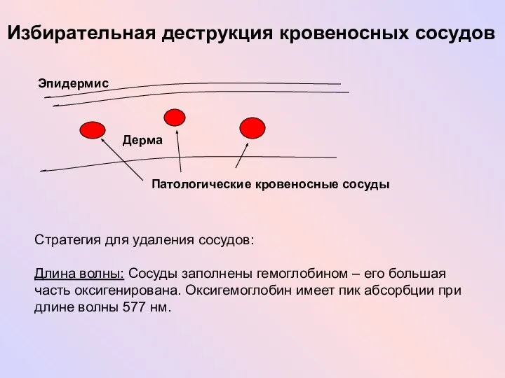 Избирательная деструкция кровеносных сосудов Эпидермис Дерма Патологические кровеносные сосуды Стратегия для