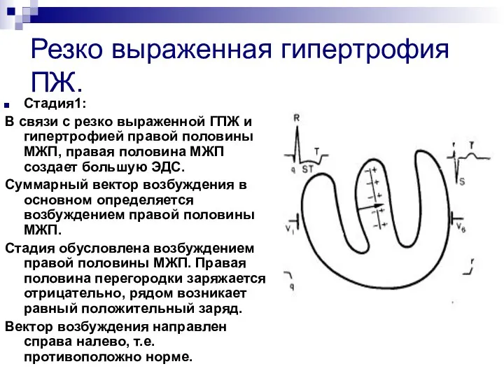 Резко выраженная гипертрофия ПЖ. Стадия1: В связи с резко выраженной ГПЖ