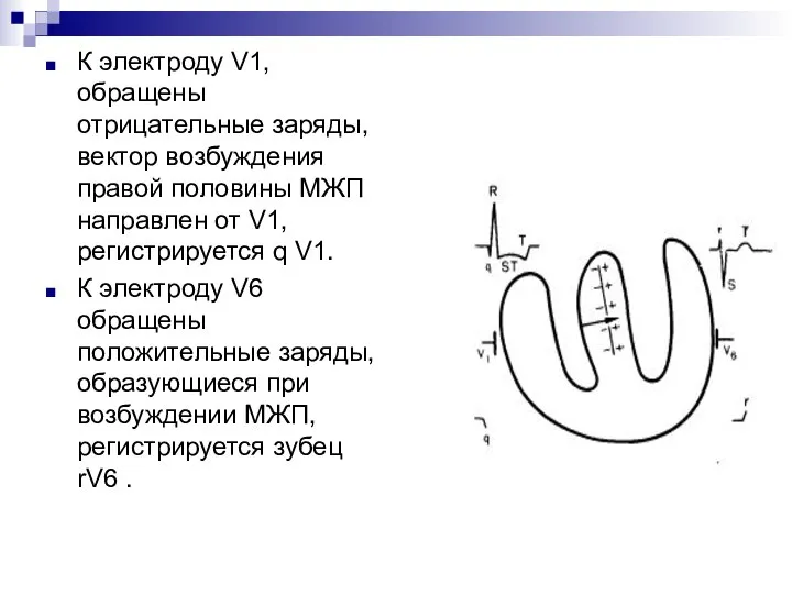 К электроду V1, обращены отрицательные заряды, вектор возбуждения правой половины МЖП