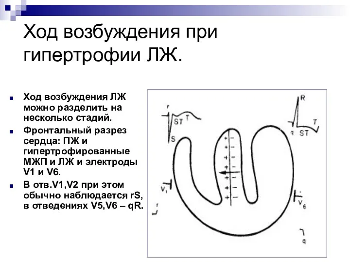 Ход возбуждения при гипертрофии ЛЖ. Ход возбуждения ЛЖ можно разделить на
