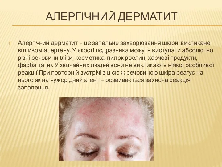 АЛЕРГІЧНИЙ ДЕРМАТИТ Алергічний дерматит – це запальне захворювання шкіри, викликане впливом