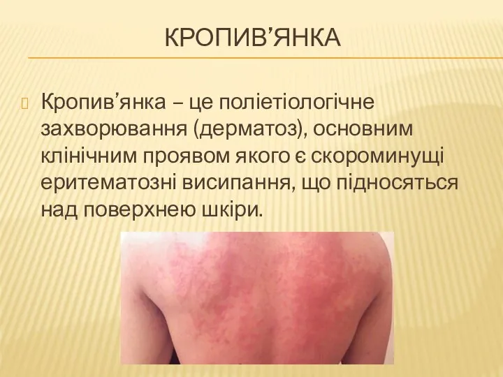 КРОПИВ’ЯНКА Кропив’янка – це поліетіологічне захворювання (дерматоз), основним клінічним проявом якого