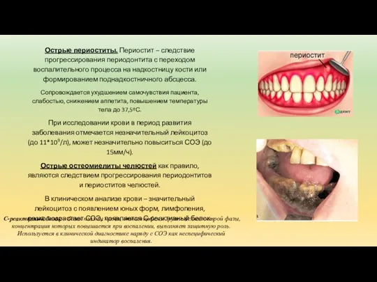 Острые периоститы. Периостит – следствие прогрессирования периодонтита с переходом воспалительного процесса