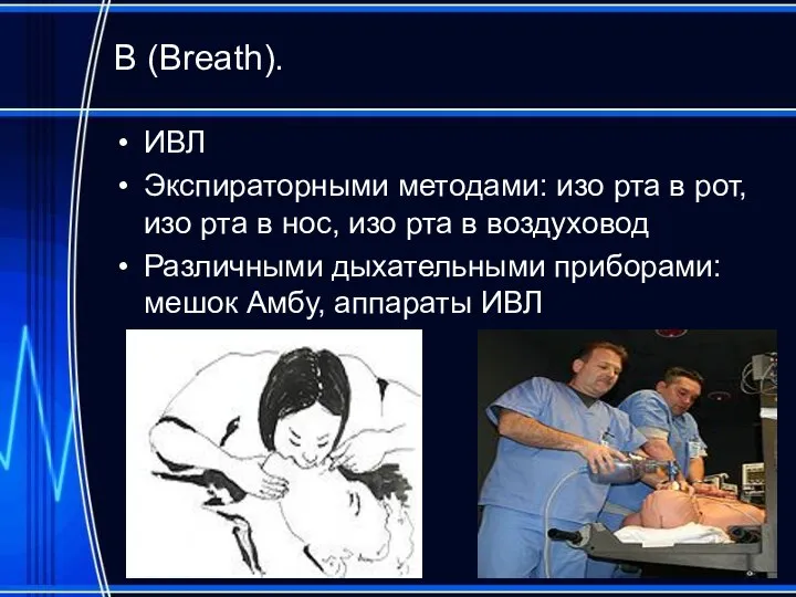 В (Breath). ИВЛ Экспираторными методами: изо рта в рот, изо рта